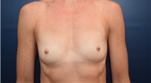 Breast Augmentation Before Photo by Michael Dobryansky, MD, FACS; Garden City, NY - Case 41756