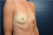 Breast Augmentation Before Photo by Michael Dobryansky, MD, FACS; Garden City, NY - Case 41756