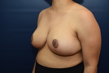 Breast Reduction After Photo by Michael Dobryansky, MD, FACS; Garden City, NY - Case 41757