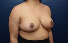 Breast Reduction After Photo by Michael Dobryansky, MD, FACS; Garden City, NY - Case 41757
