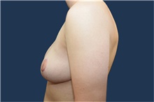 Breast Reduction After Photo by Michael Dobryansky, MD, FACS; Garden City, NY - Case 42522