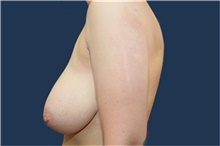 Breast Reduction Before Photo by Michael Dobryansky, MD, FACS; Garden City, NY - Case 42522
