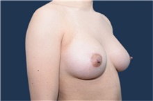 Breast Augmentation After Photo by Michael Dobryansky, MD, FACS; Garden City, NY - Case 42523