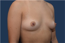 Breast Augmentation Before Photo by Michael Dobryansky, MD, FACS; Garden City, NY - Case 42523