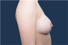 Breast Augmentation After Photo by Michael Dobryansky, MD, FACS; Garden City, NY - Case 42523