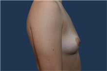 Breast Augmentation Before Photo by Michael Dobryansky, MD, FACS; Garden City, NY - Case 42523