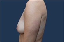 Breast Augmentation Before Photo by Michael Dobryansky, MD, FACS; Garden City, NY - Case 42524