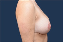 Breast Augmentation After Photo by Michael Dobryansky, MD, FACS; Garden City, NY - Case 42524