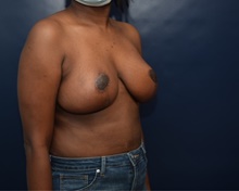 Breast Reduction After Photo by Michael Dobryansky, MD, FACS; Garden City, NY - Case 43247