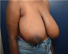 Breast Reduction Before Photo by Michael Dobryansky, MD, FACS; Garden City, NY - Case 43247
