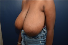 Breast Reduction Before Photo by Michael Dobryansky, MD, FACS; Garden City, NY - Case 43247
