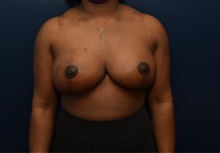 Breast Reduction After Photo by Michael Dobryansky, MD, FACS; Garden City, NY - Case 43248