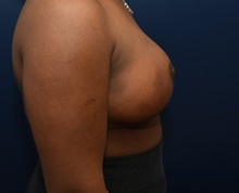 Breast Reduction After Photo by Michael Dobryansky, MD, FACS; Garden City, NY - Case 43248