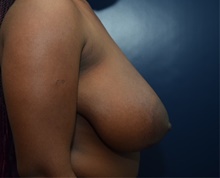 Breast Reduction Before Photo by Michael Dobryansky, MD, FACS; Garden City, NY - Case 43248