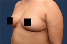 Breast Reduction After Photo by Michael Dobryansky, MD, FACS; Garden City, NY - Case 43249