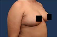 Breast Reduction After Photo by Michael Dobryansky, MD, FACS; Garden City, NY - Case 43249