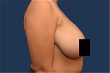 Breast Reduction Before Photo by Michael Dobryansky, MD, FACS; Garden City, NY - Case 43249