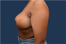 Breast Reduction After Photo by Michael Dobryansky, MD, FACS; Garden City, NY - Case 43251