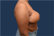 Breast Reduction After Photo by Michael Dobryansky, MD, FACS; Garden City, NY - Case 43251