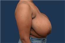 Breast Reduction Before Photo by Michael Dobryansky, MD, FACS; Garden City, NY - Case 43251