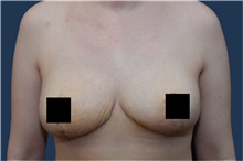 Breast Reduction After Photo by Michael Dobryansky, MD, FACS; Garden City, NY - Case 43252