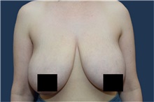 Breast Reduction Before Photo by Michael Dobryansky, MD, FACS; Garden City, NY - Case 43252