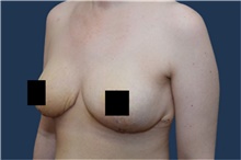 Breast Reduction After Photo by Michael Dobryansky, MD, FACS; Garden City, NY - Case 43252