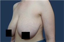 Breast Reduction Before Photo by Michael Dobryansky, MD, FACS; Garden City, NY - Case 43252