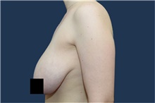 Breast Reduction Before Photo by Michael Dobryansky, MD, FACS; Garden City, NY - Case 43252