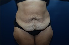 Tummy Tuck Before Photo by Michael Dobryansky, MD, FACS; Garden City, NY - Case 43253