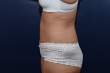 Tummy Tuck After Photo by Michael Dobryansky, MD, FACS; Garden City, NY - Case 43253