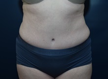 Tummy Tuck After Photo by Michael Dobryansky, MD, FACS; Garden City, NY - Case 43254