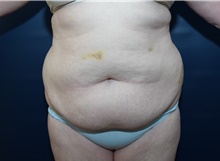 Tummy Tuck Before Photo by Michael Dobryansky, MD, FACS; Garden City, NY - Case 43254