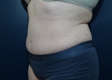 Tummy Tuck After Photo by Michael Dobryansky, MD, FACS; Garden City, NY - Case 43254
