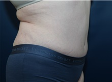 Tummy Tuck After Photo by Michael Dobryansky, MD, FACS; Garden City, NY - Case 43254