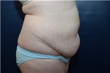 Tummy Tuck Before Photo by Michael Dobryansky, MD, FACS; Garden City, NY - Case 43254