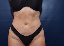 Liposuction After Photo by Michael Dobryansky, MD, FACS; Garden City, NY - Case 43255