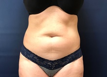 Liposuction Before Photo by Michael Dobryansky, MD, FACS; Garden City, NY - Case 43255