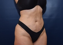 Liposuction After Photo by Michael Dobryansky, MD, FACS; Garden City, NY - Case 43255