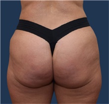 Buttock Lift with Augmentation After Photo by Michael Dobryansky, MD, FACS; Garden City, NY - Case 43256