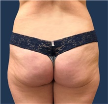 Buttock Lift with Augmentation Before Photo by Michael Dobryansky, MD, FACS; Garden City, NY - Case 43256