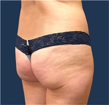 Buttock Lift with Augmentation Before Photo by Michael Dobryansky, MD, FACS; Garden City, NY - Case 43256
