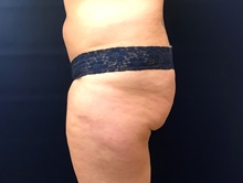 Buttock Lift with Augmentation Before Photo by Michael Dobryansky, MD, FACS; Garden City, NY - Case 43256