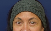 Eyelid Surgery After Photo by Michael Dobryansky, MD, FACS; Garden City, NY - Case 43258