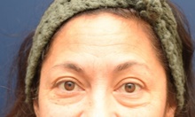 Eyelid Surgery Before Photo by Michael Dobryansky, MD, FACS; Garden City, NY - Case 43258