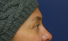 Eyelid Surgery After Photo by Michael Dobryansky, MD, FACS; Garden City, NY - Case 43258