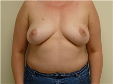 Breast Reconstruction Before Photo by Michael Dobryansky, MD, FACS; Garden City, NY - Case 46234
