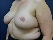 Breast Reconstruction After Photo by Michael Dobryansky, MD, FACS; Garden City, NY - Case 46234