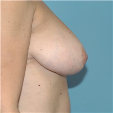 Breast Reduction After Photo by Tracy Pfeifer, MD; New York, NY - Case 32150