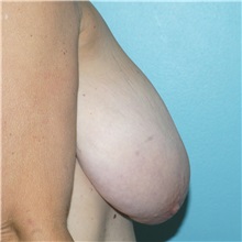 Breast Reduction Before Photo by Tracy Pfeifer, MD; New York, NY - Case 32150